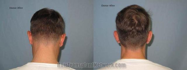 Hair transplant surgery before and after photos