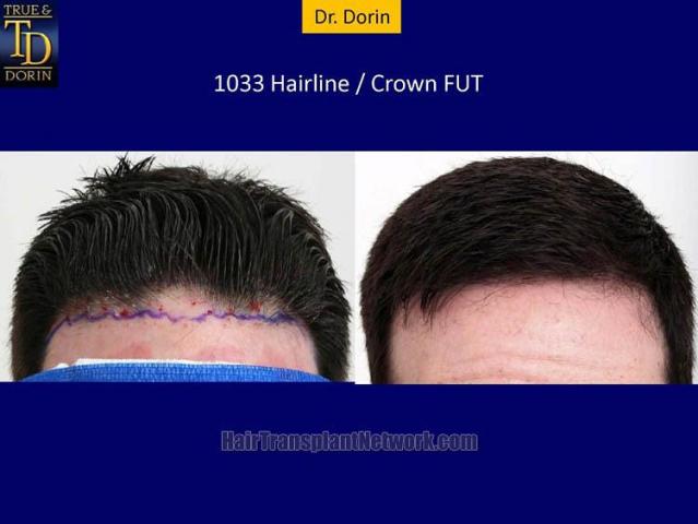 Hair transplantation surgery before and after photos