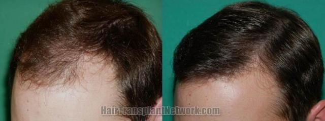 Hair restoration procedure results