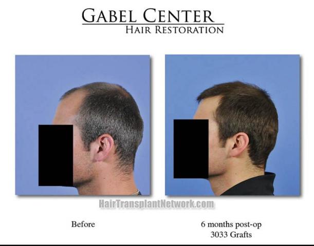 Hair transplantation surgery before and after photos