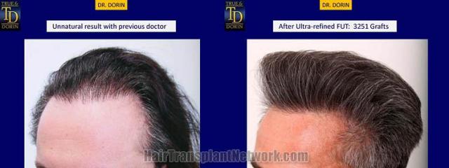 Hair transplantation surgery before and after images