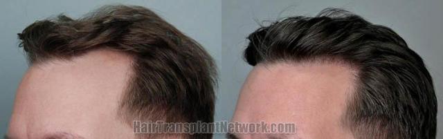 Hair transplantation surgery before and after images