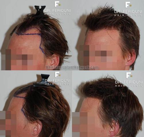 Hair transplantation surgery before and after pictures