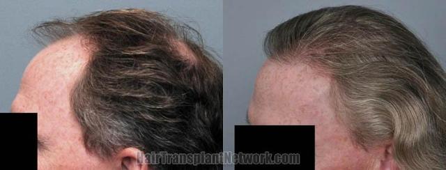 Hair transplantation surgery before and after images