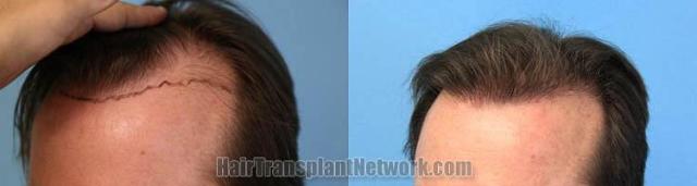 Hair transplantation surgery before and after images