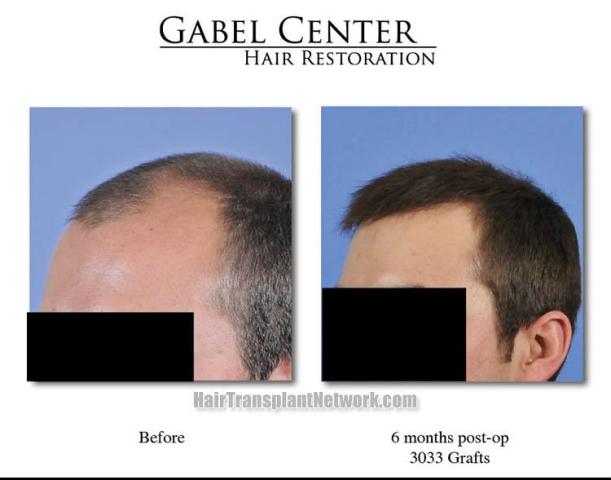 Hair restoration procedure before and after pictures