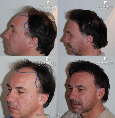 Photos of before and after hair transplant procedure