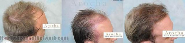 Hair restoration procedure before and after results