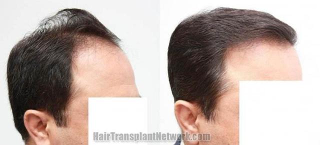 Hair restoration procedure before and after results