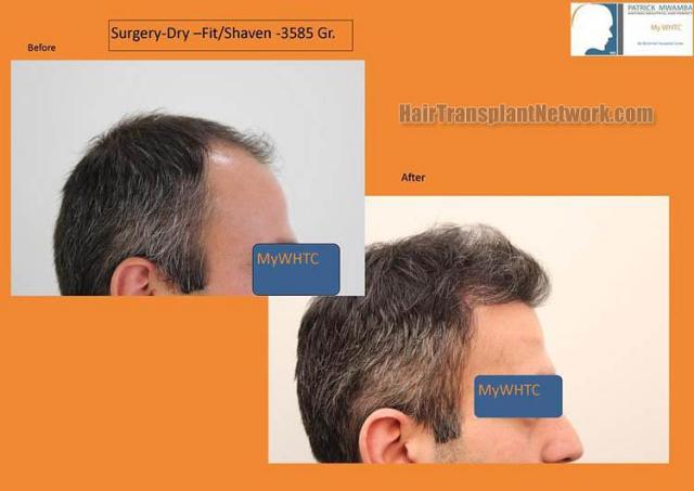 Hair transplantation surgery before and after images