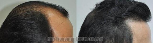 Hair transplantation surgery before and after images