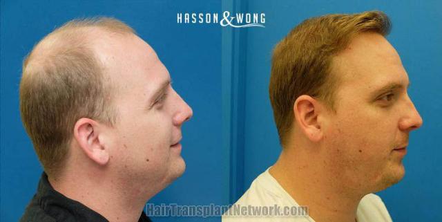 Hair restoration procedure before and after results