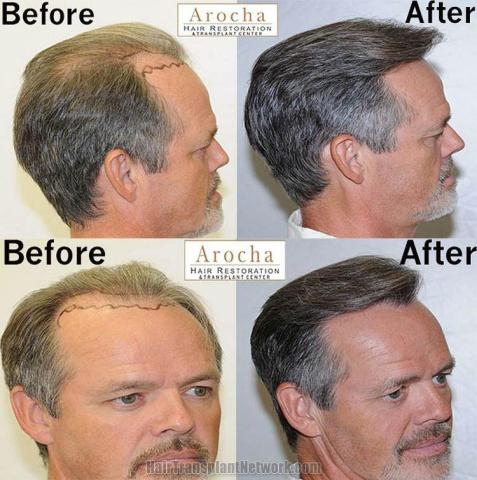 Hair transplantation surgery before and after photos