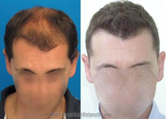 Top view - Before and after surgical hair replacement