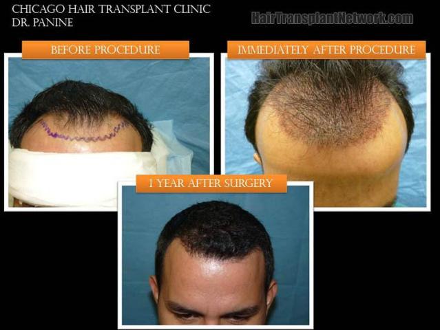 Hair transplant surgery before and after pictures