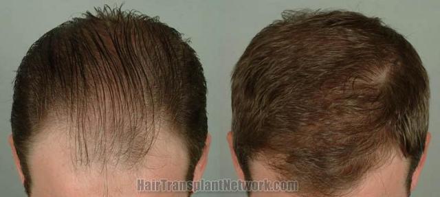 Hair transplantation surgery before and after pictures