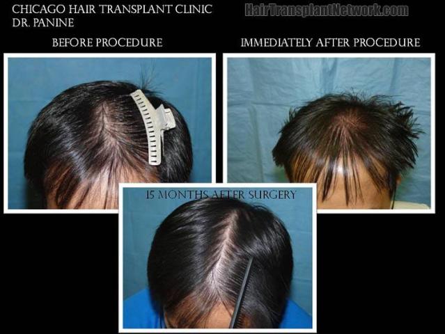 Top view - Before and after hair transplantation photos