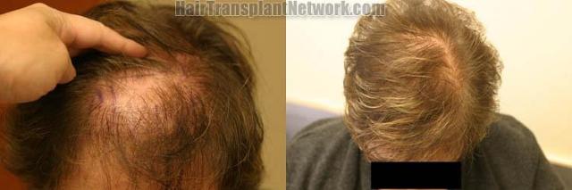 Hair transplantation surgery before and after images