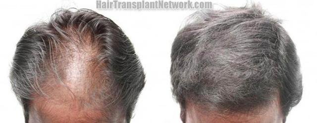 Top view - Before and after surgical hair replacement