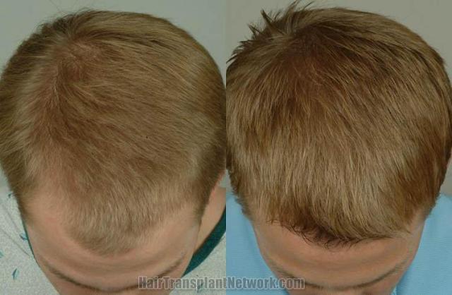 Hair transplantation surgery before and after pictures