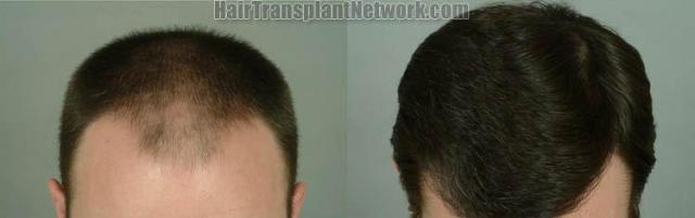 Hair restoration procedure before and after pictures