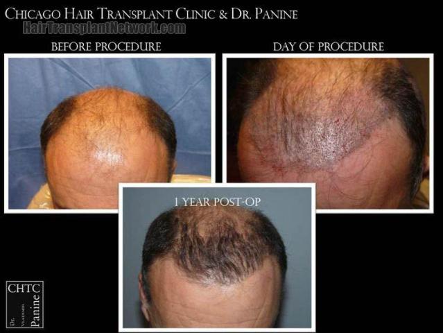 Hair restoration procedure before and after results