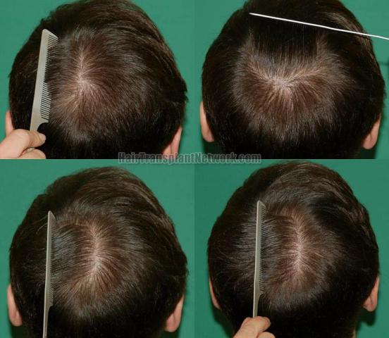 Hair transplantation surgery after images