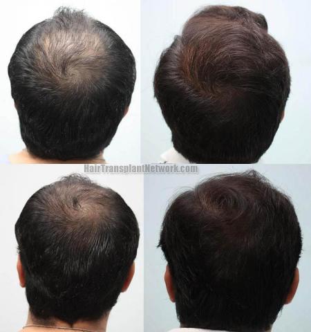 Hair restoration procedure before and after pictures