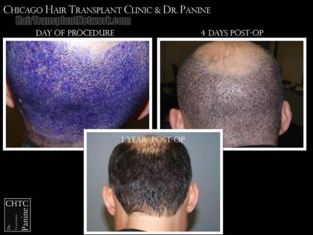 Hair transplantation surgery before and after pictures