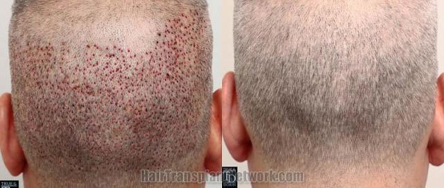 Hair restoration procedure before and after pictures