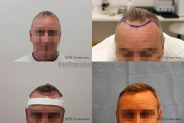 Hair restoration procedure before and after results