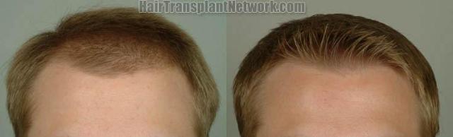 Hair transplantation surgery before and after images