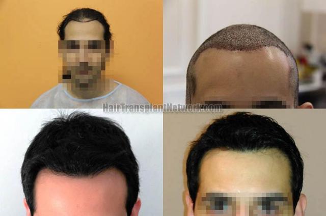 Hair restoration procedure before and after results