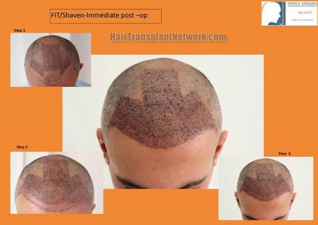 Hair restoration surgery before and after images