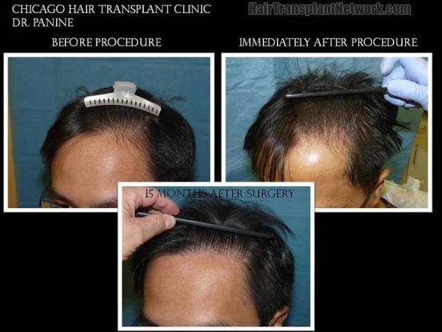 Before and after hair restoration photographs