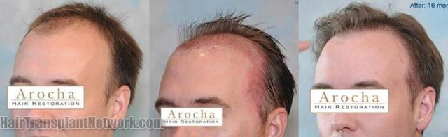 Hair transplantation surgery before and after photos