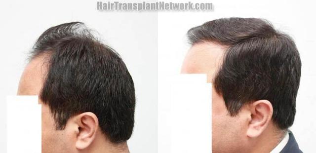 Hair transplantation surgery before and after photos