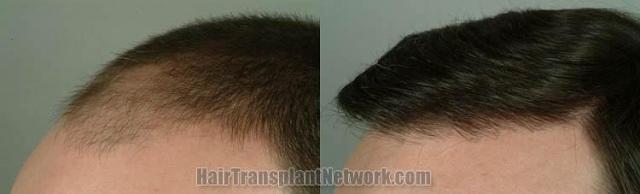 Hair transplantation surgery before and after images