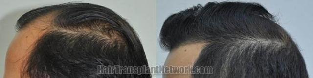 Hair transplantation surgery before and after pictures