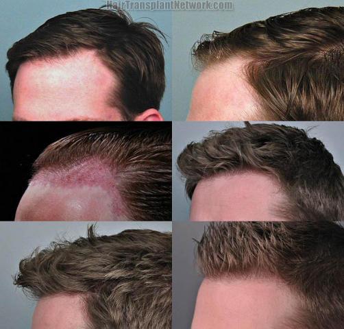 Hair transplantation surgery before and after pictures