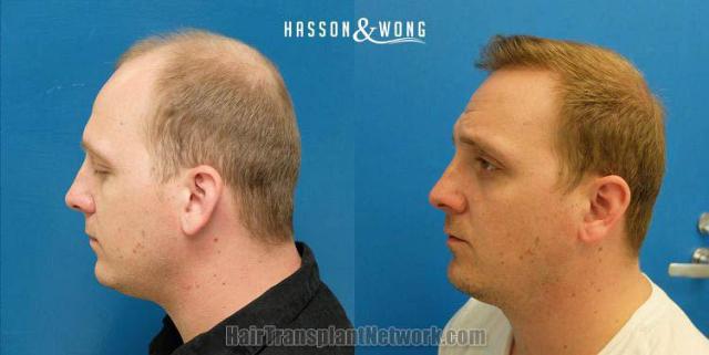 Hair transplantation surgery before and after photos