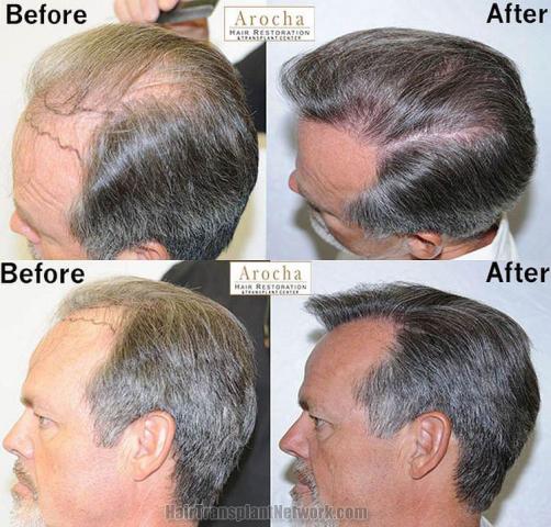 Hair transplantation surgery before and after images