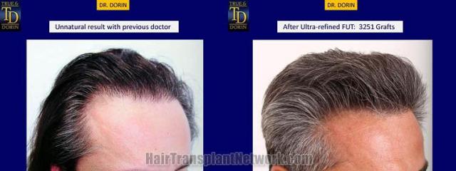 Hair transplantation surgery before and after photos