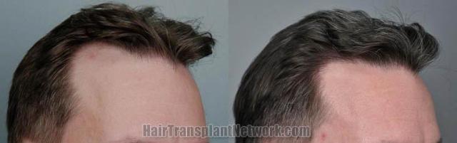 Hair transplantation surgery before and after photos