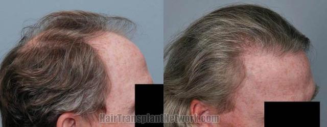 Hair transplantation surgery before and after photos