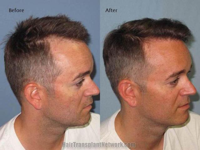 Hair transplantation surgery before and after photos