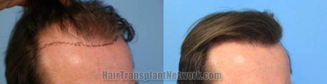 Hair transplantation surgery before and after photos