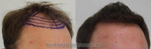 Hair transplantation surgery before and after photos