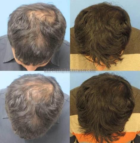 Before and after hair transplantation photos