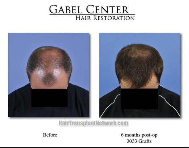 Top view before and after hair restoration results